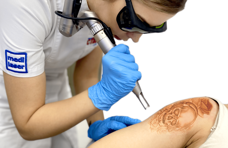 laserowe-usuwanie-tatuazu-Medilaser-Wroclaw-q9082y5s4dzlpgj627687w0vx6iokydm16wfyjpi88
